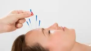A woman receiving an acupuncture South Calgary treatment.