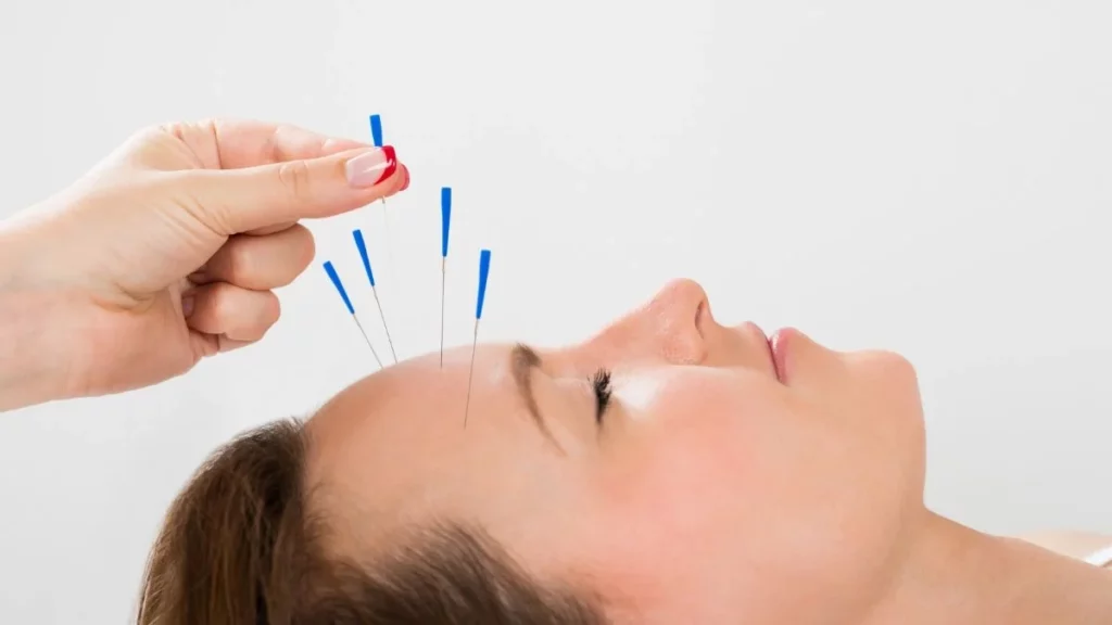 An effective acupuncture treatment for migraines targeting the head of a woman.