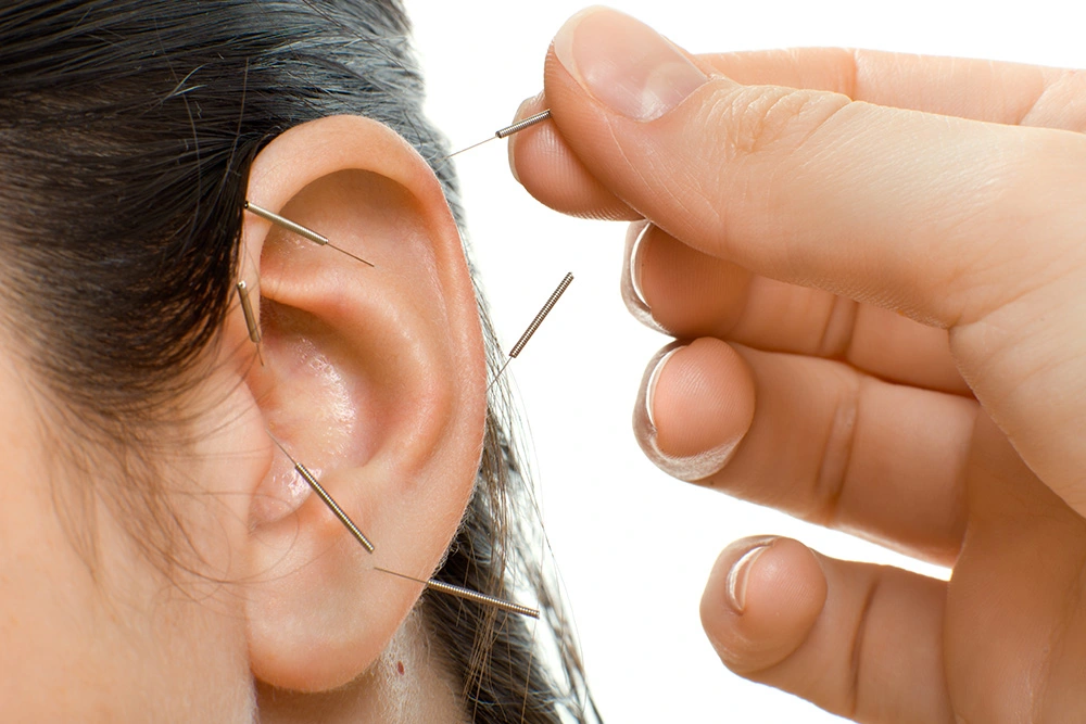 A woman is receiving acupuncture needles on her ear.